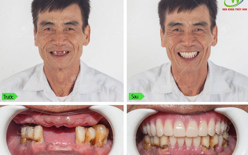 nhung-cach-trong-rang-gia-hien-nay-4 nhung-cach-trong-rang-gia-hien-nay-4