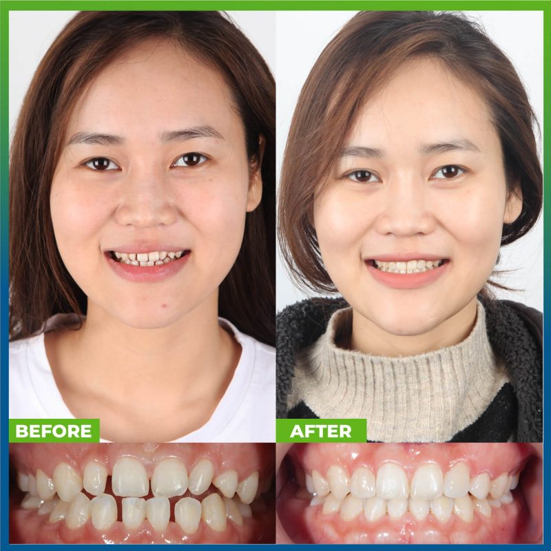 nieng-rang-invisalign-trang-chu-2 (1) nieng-rang-invisalign-trang-chu-2 (1)
