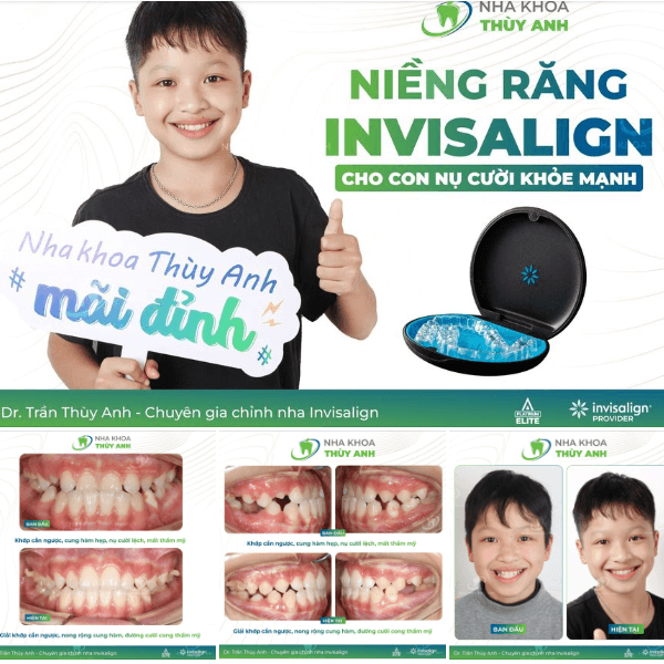 nieng-rang-khop-can-nguoc-1 (1) nieng-rang-khop-can-nguoc-1 (1)