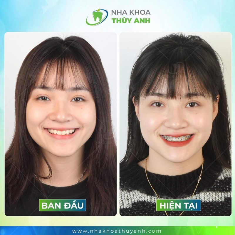 nieng-rang-mom-bac-giang-1 (1) nieng-rang-mom-bac-giang-1 (1)