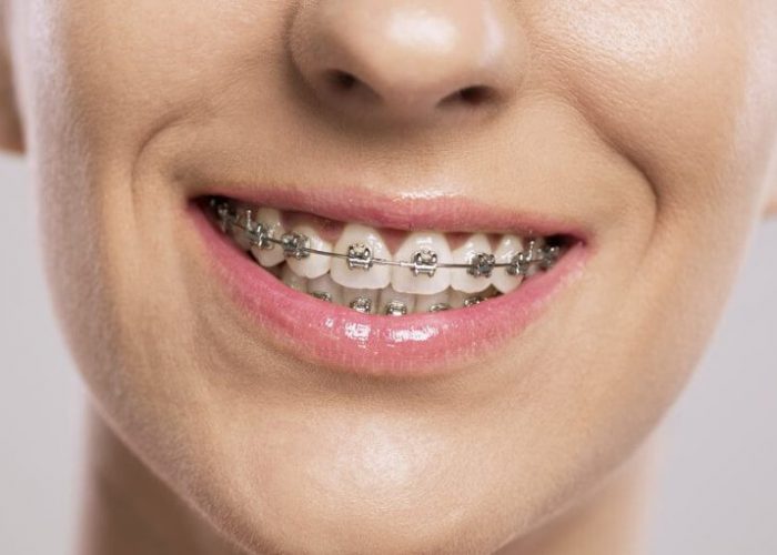 Niềng răng mắc cài kim loại - Niềng răng giá rẻ tại Đà Nẵng