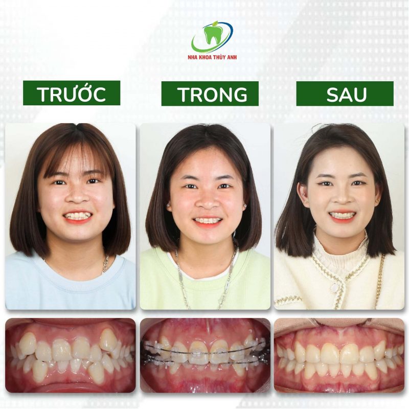 nieng-rang-sieu-khap-khenh-2 nieng-rang-sieu-khap-khenh-2