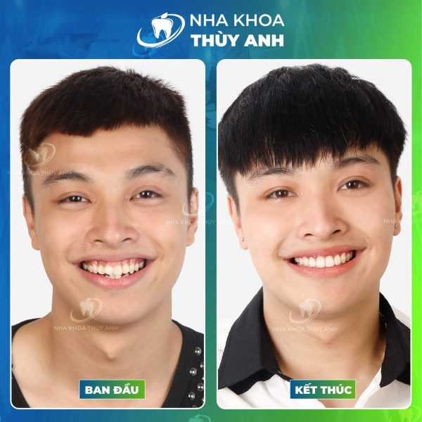 nieng-rang-tra-gop-thai-nguyen-1 (1) nieng-rang-tra-gop-thai-nguyen-1 (1)
