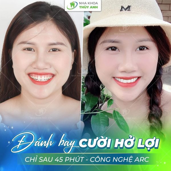 phau-thuat-cuoi-ho-loi-thai-nguyen (1) phau-thuat-cuoi-ho-loi-thai-nguyen (1)