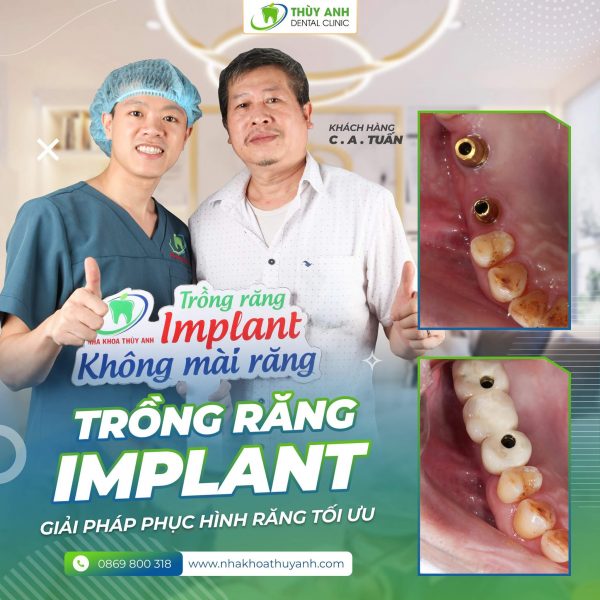 trong-rang-implant-cho-nguoi-gia (1)