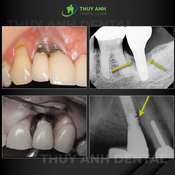 Hậu quả khôn lường của việc trồng răng implant giá rẻ - nhakhoathuyanh